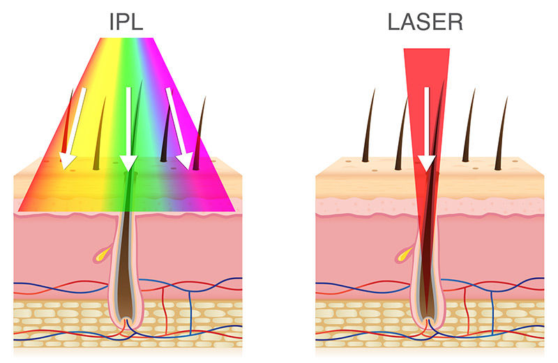 Epilarea cu Laser vindecă Foliculita